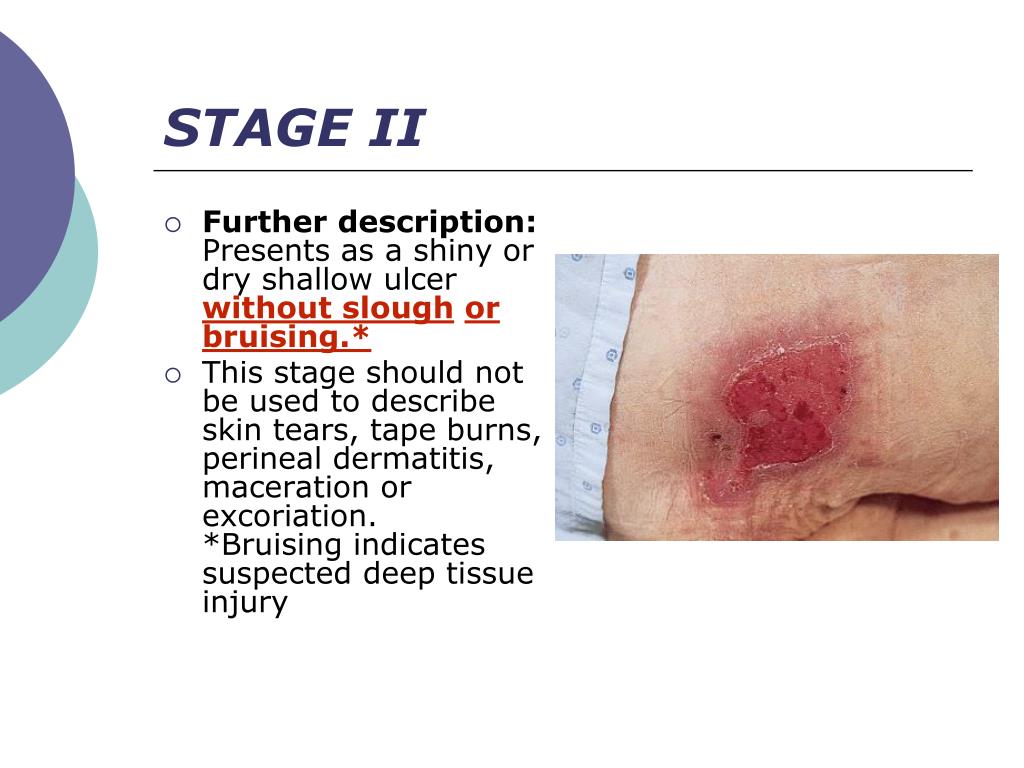 Wound Dressing For Stage 3 Pressure Ulcer At Wilfred Mitchell Blog