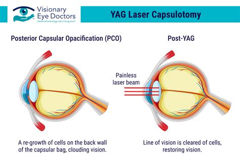 Yag Capsulotomy Procedure