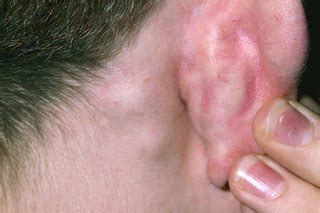 Yeast Infection Behind Baby Amp 39 S Ear 7 Causes And Solutions