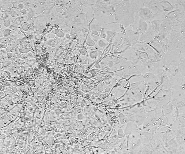 Yeast Wet Mount: Quick Diagnosis Guide