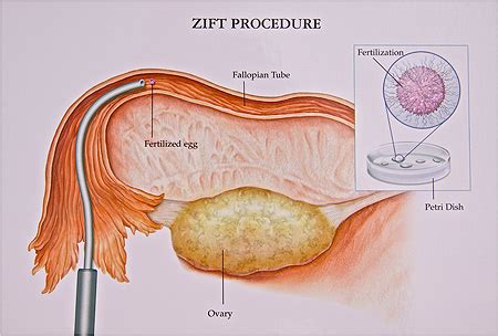 Zygote Intrafallopian Transfer Zift Women Health Info Blog